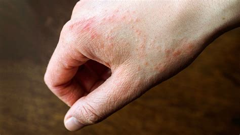 Can lume cause a rash. Things To Know About Can lume cause a rash. 